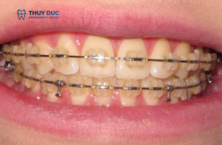 6 mẹo hữu ích để khắc phục mắc cài sứ bị vàng 1 6 mẹo hữu ích để khắc phục mắc cài sứ bị vàng 1