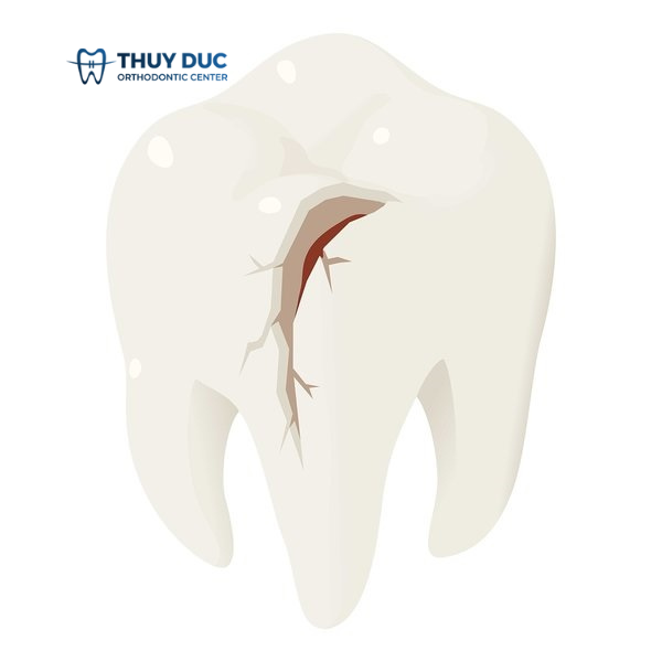 Men răng là gì? 1 Men răng là gì? 1