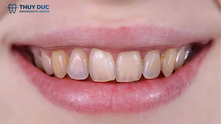 Triệu chứng hư men răng 1