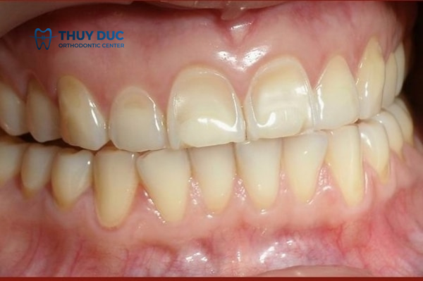 Mòn men răng 1 Mòn men răng 1