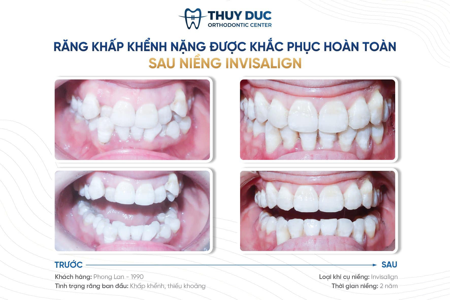 1.1. Hiệu quả chỉnh nha 1