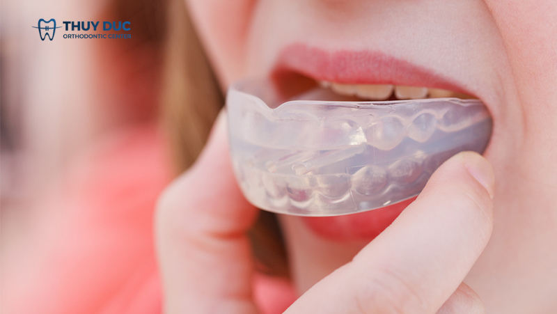 2. Phân loại niềng răng Trainer A1, A2, A3 1