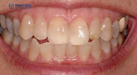 Các yếu tố ảnh hưởng đến men răng 3 Các yếu tố ảnh hưởng đến men răng 3