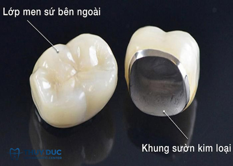 Răng sứ kim loại 1