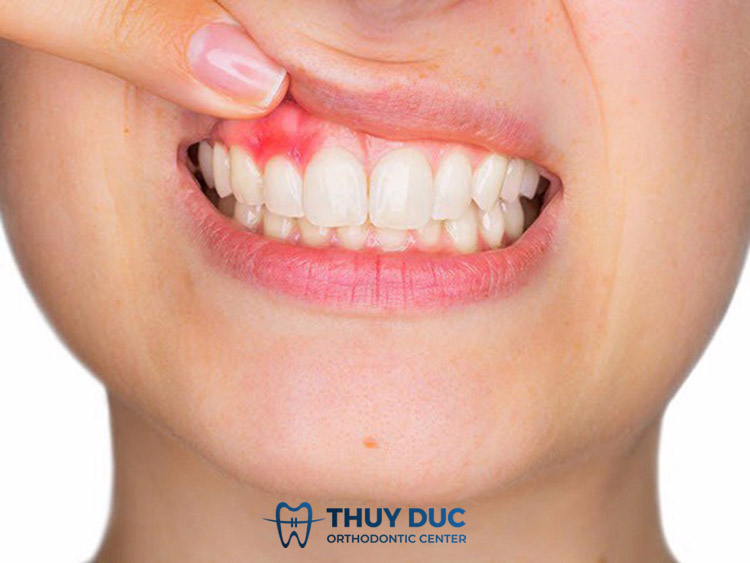 1. Dấu hiệu nhận biết bọc răng sứ bị viêm lợi 1