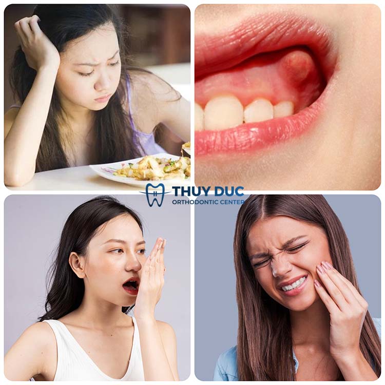 3. Bọc răng sứ bị viêm lợi có nguy hiểm không? 1