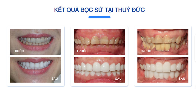 7. Mách bạn địa chỉ bọc răng toàn sứ chất lượng tại Hà Nội 2 7. Mách bạn địa chỉ bọc răng toàn sứ chất lượng tại Hà Nội 2