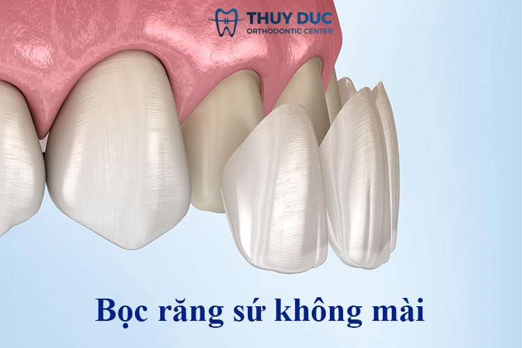 1. Bọc răng sứ không mài là gì? 1