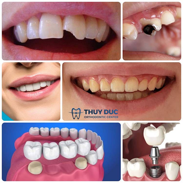 3. Trường hợp nào nên bọc răng sứ Titan? 1 3. Trường hợp nào nên bọc răng sứ Titan? 1