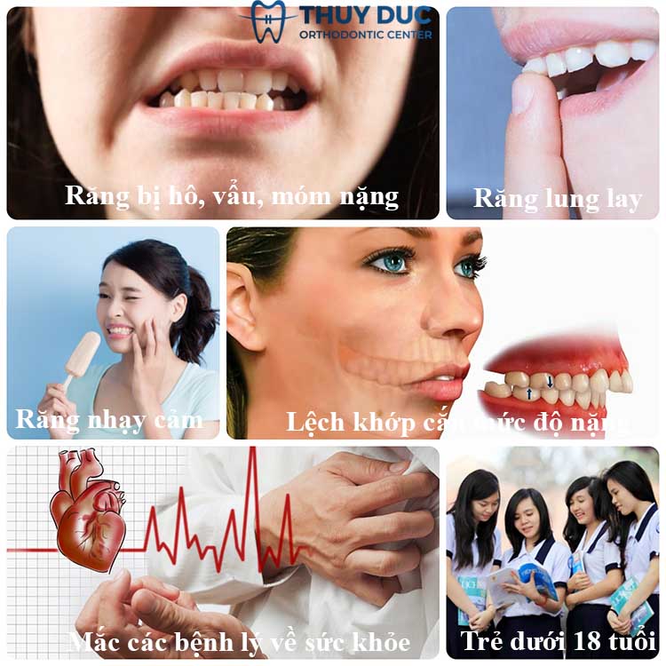 Các trường hợp không nên bọc răng toàn sứ 1 Các trường hợp không nên bọc răng toàn sứ 1