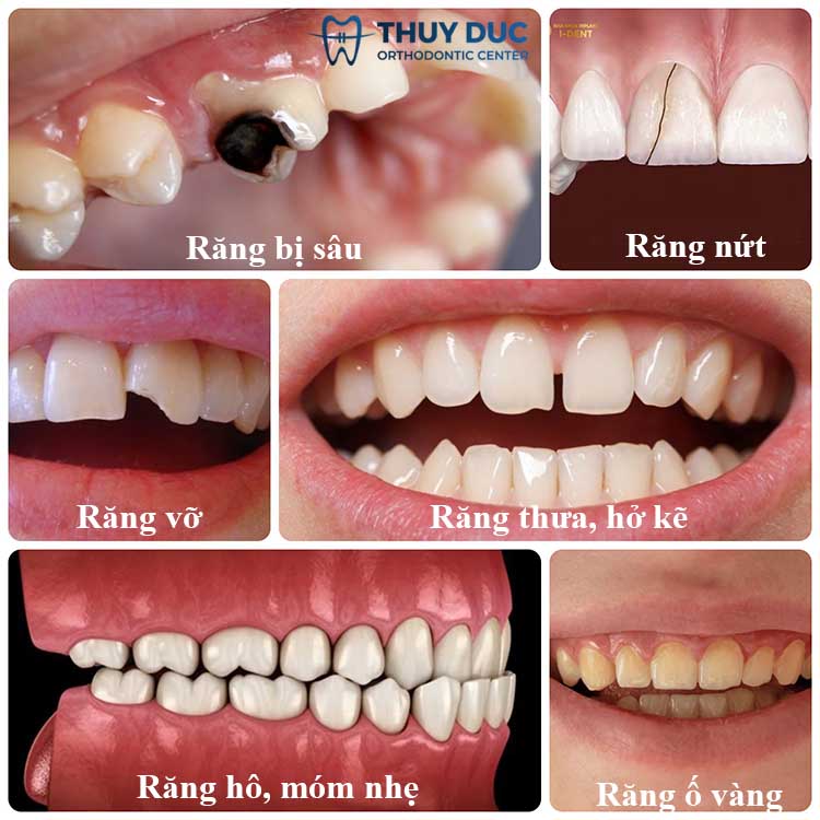 Các trường hợp nên bọc răng toàn sứ 1 Các trường hợp nên bọc răng toàn sứ 1
