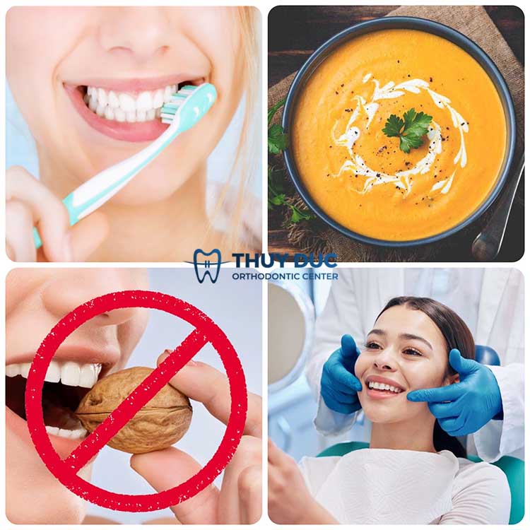 4. Cách chăm sóc sau khi bọc răng sứ 1 4. Cách chăm sóc sau khi bọc răng sứ 1