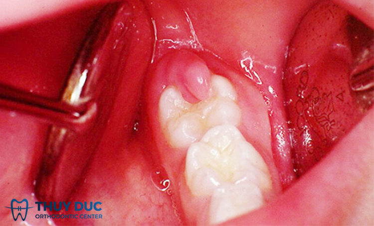 Dấu hiệu mọc răng khôn hàm dưới 1 Dấu hiệu mọc răng khôn hàm dưới 1