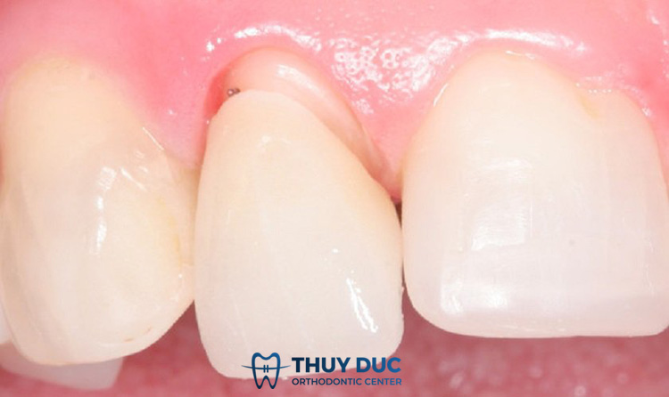 Những dấu hiệu nhận biết răng sứ bị hở thường gặp 1