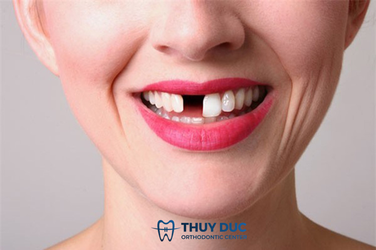 3. Biến chứng nguy hiểm khi bọc sứ bị viêm tuỷ 1 3. Biến chứng nguy hiểm khi bọc sứ bị viêm tuỷ 1