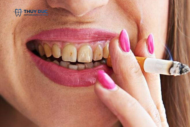 Các yếu tố ảnh hưởng đến men răng 4 Các yếu tố ảnh hưởng đến men răng 4