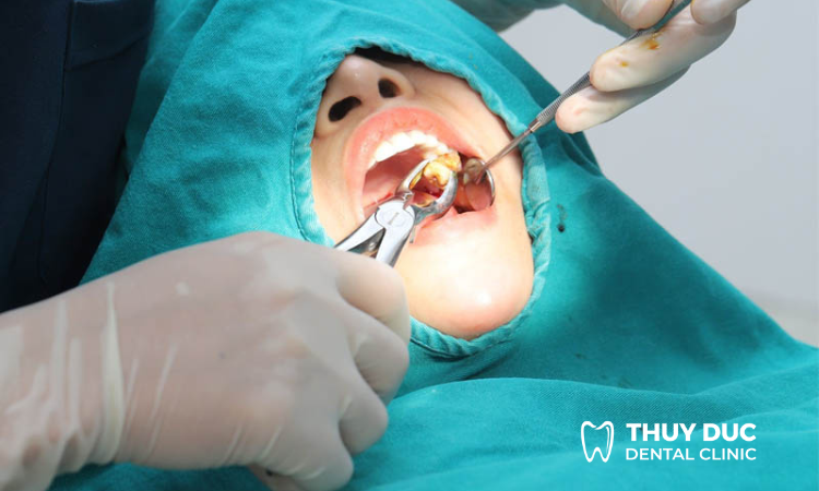 3. Quy trình nhổ răng khôn chuẩn y khoa 1