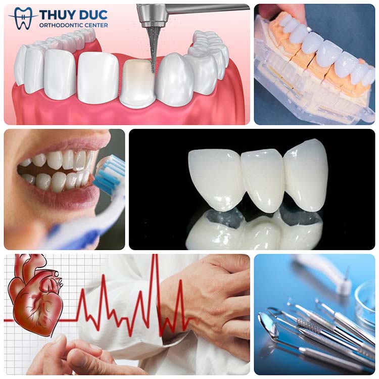 2. Những nguyên nhân làm cho bọc răng sứ bị viêm lợi 1