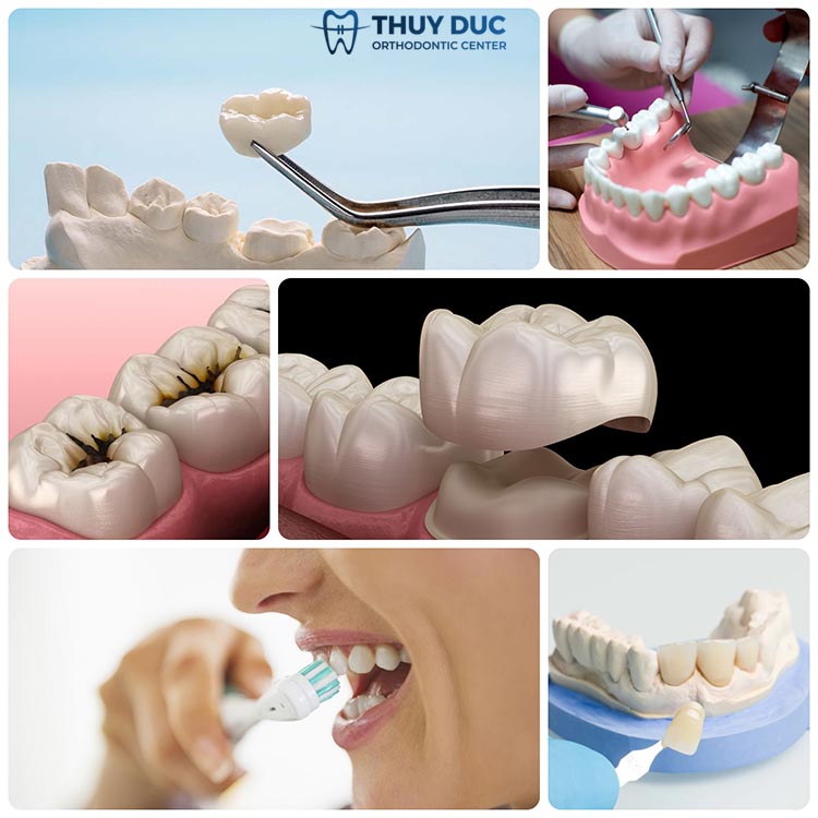 2. Những nguyên nhân gây răng bọc sứ bị viêm tuỷ 1 2. Những nguyên nhân gây răng bọc sứ bị viêm tuỷ 1