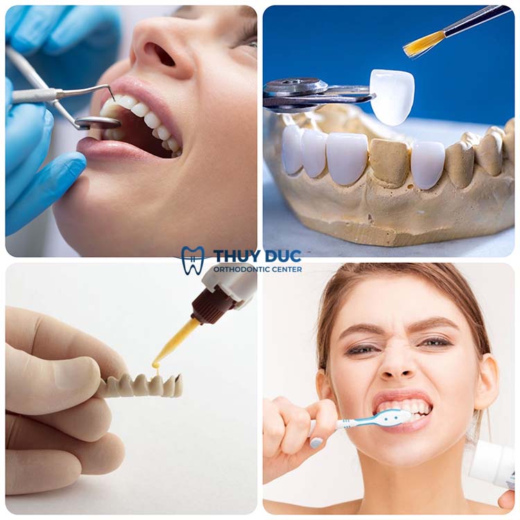 Nguyên nhân làm răng sứ bị hở 1