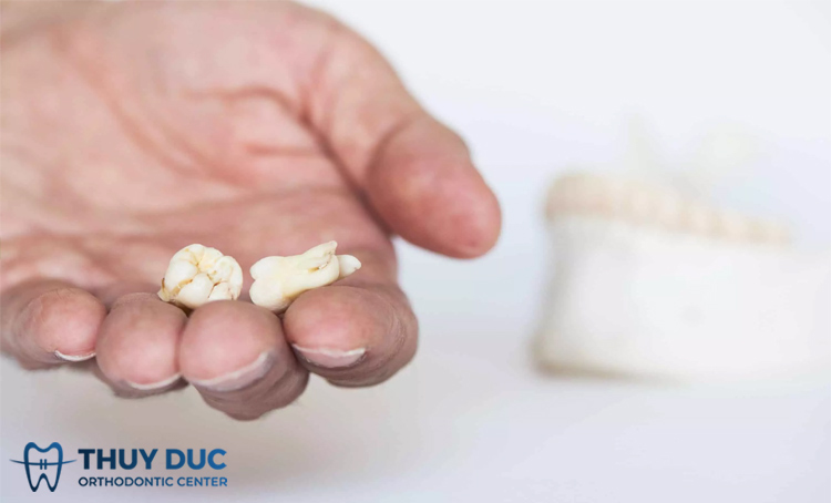 Nhổ 2 răng khôn cùng lúc có sao không? 1 Nhổ 2 răng khôn cùng lúc có sao không? 1