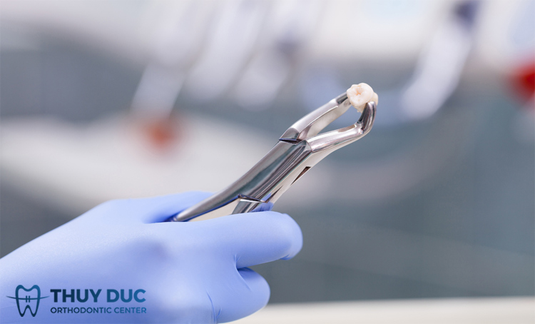 Có nên nhổ bỏ 4 răng khôn cùng lúc không? 1