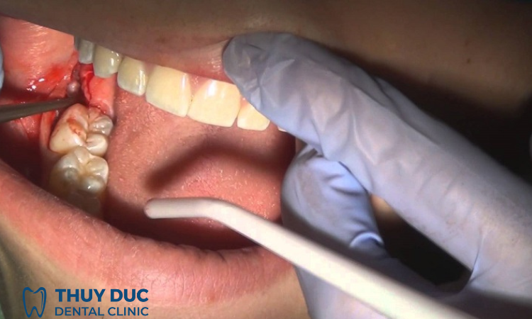 Bước 3: Làm lung lay chân răng 1