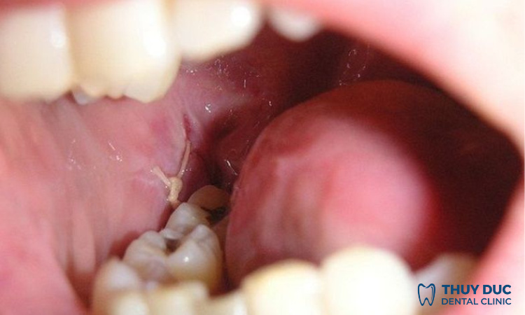 Nhổ răng khôn bao lâu thì lành thương hẳn hoàn toàn? 1