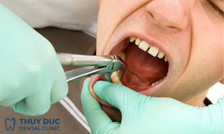 Nhổ răng khôn mất thời gian bao lâu? 1