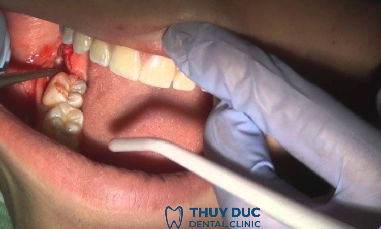 Các nguyên nhân nhổ răng khôn bị sưng mặt? 1