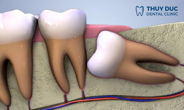 Răng khôn là răng gì? 1