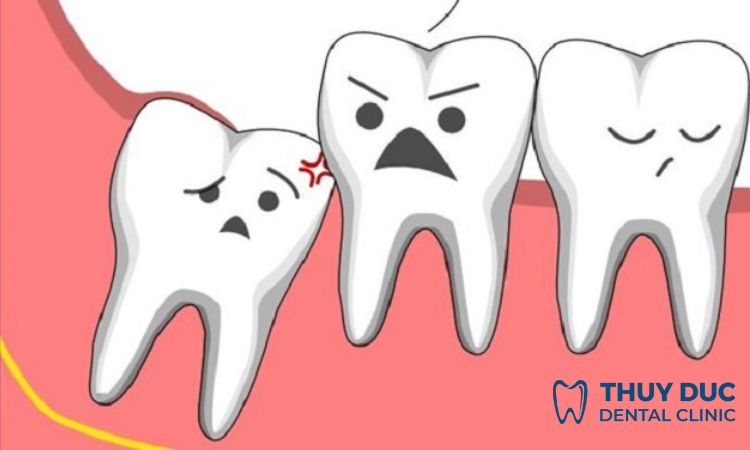 Răng khôn mọc sai vị trí 1 Răng khôn mọc sai vị trí 1