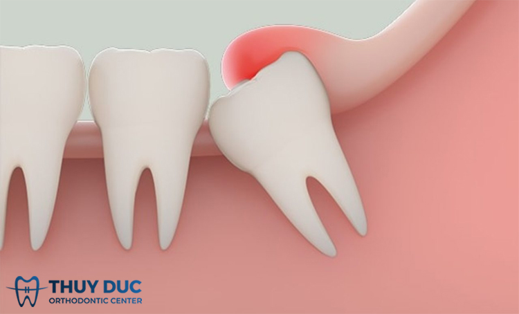 Các trường hợp nên nhổ răng khôn hàm dưới 1 Các trường hợp nên nhổ răng khôn hàm dưới 1