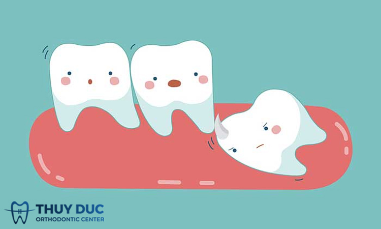 Khi nào nhổ răng khôn ít sưng đau nhất? 1 Khi nào nhổ răng khôn ít sưng đau nhất? 1