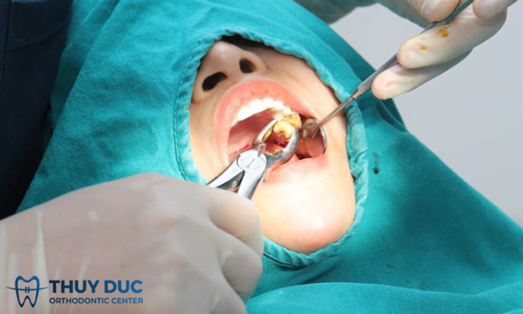 Lưu ý để nhổ 4 răng khôn an toàn, không biến chứng 1