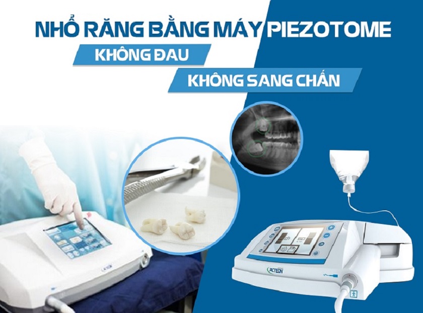 Quy trình nhổ răng tại Nha Khoa Thúy Đức 1 Quy trình nhổ răng tại Nha Khoa Thúy Đức 1