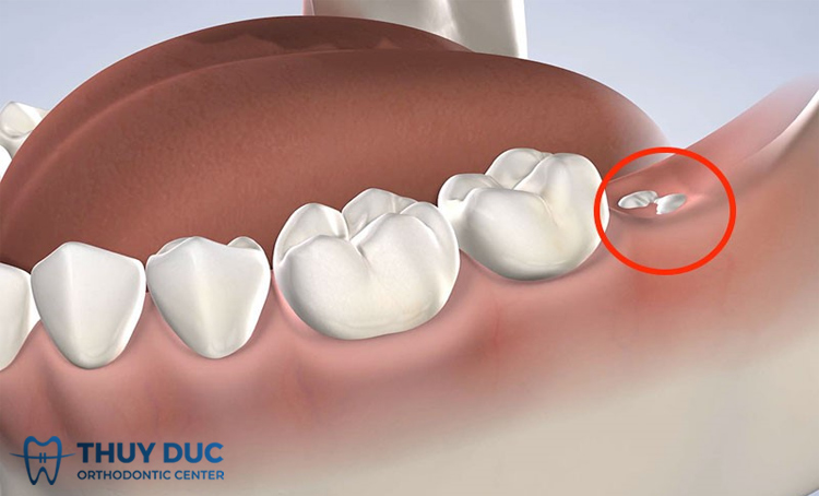 Có nên nhổ răng khôn hàm dưới hay không? 1 Có nên nhổ răng khôn hàm dưới hay không? 1