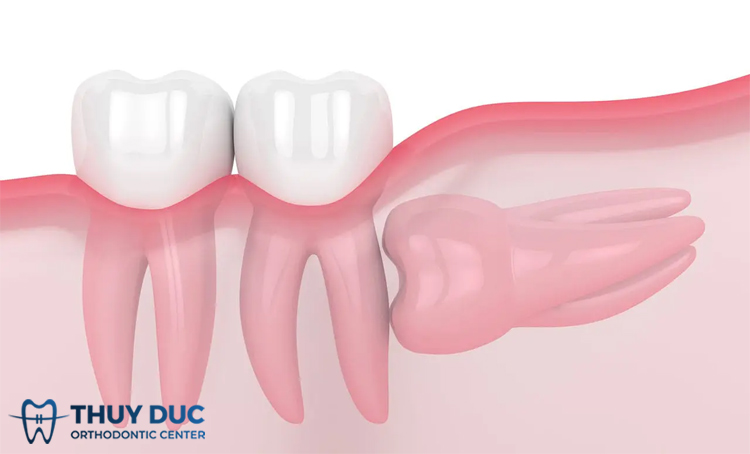 Răng khôn mọc ngang có nguy hiểm không? Có phải nhổ không? 1 Răng khôn mọc ngang có nguy hiểm không? Có phải nhổ không? 1