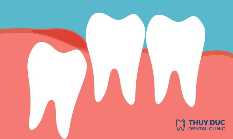 Trường hợp không phải nhổ răng khôn 1