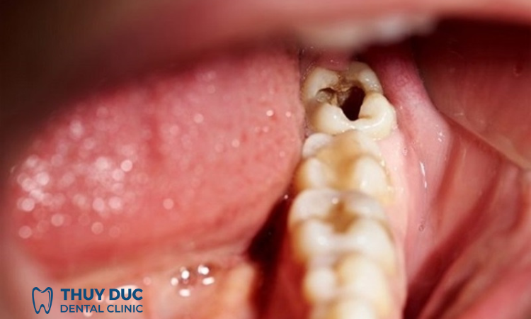 Sâu răng 1 Sâu răng 1