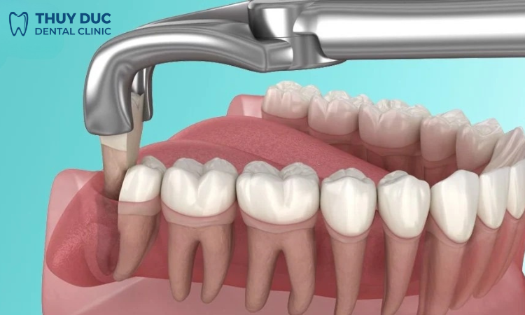 Răng khôn mọc thẳng như thế nào? 1
