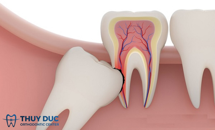 Làm hỏng răng số 7 1 Làm hỏng răng số 7 1