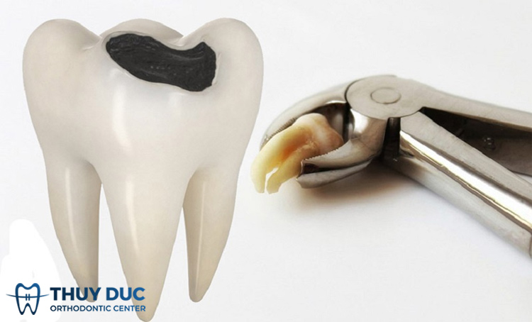Khi nào cần nhổ răng số 8 hàm trên bị sâu? 1 Khi nào cần nhổ răng số 8 hàm trên bị sâu? 1