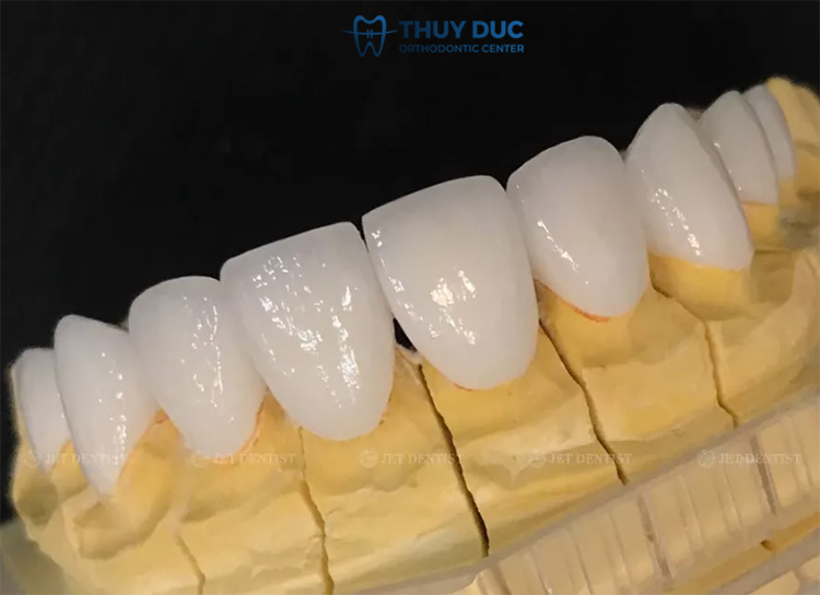 Răng toàn sứ Ceramill 1 Răng toàn sứ Ceramill 1