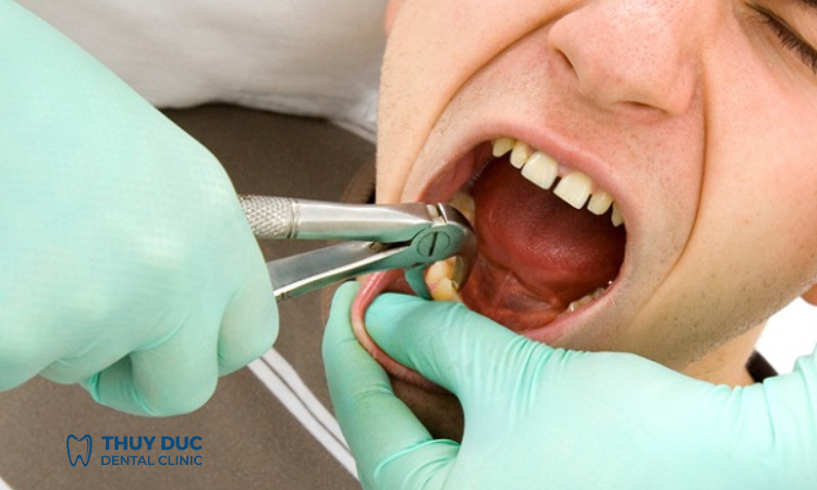 Trường hợp nào nên nhổ răng khôn? 1 Trường hợp nào nên nhổ răng khôn? 1