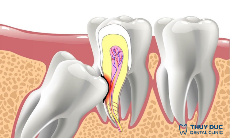 Nguyên nhân gây đau răng khôn? 1 Nguyên nhân gây đau răng khôn? 1