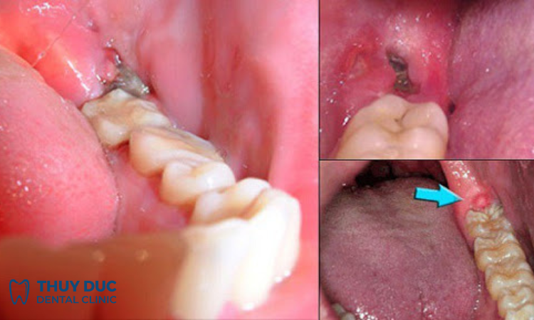 U nang xương hàm 1 U nang xương hàm 1