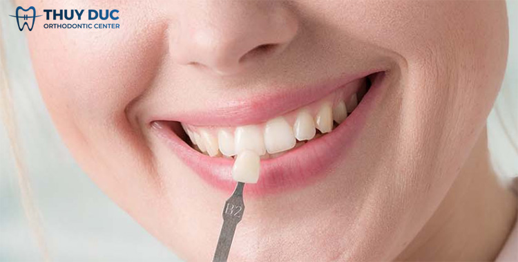 2. Ưu nhược điểm của bọc răng sứ không mài 1