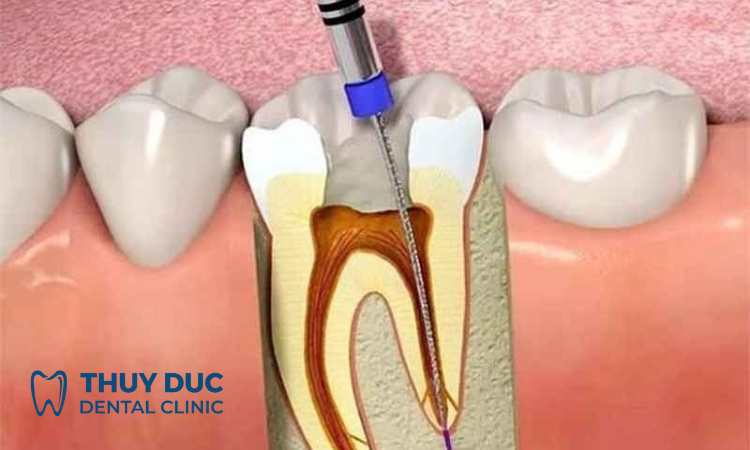 Cách điều trị răng sâu vào tủy 1 Cách điều trị răng sâu vào tủy 1