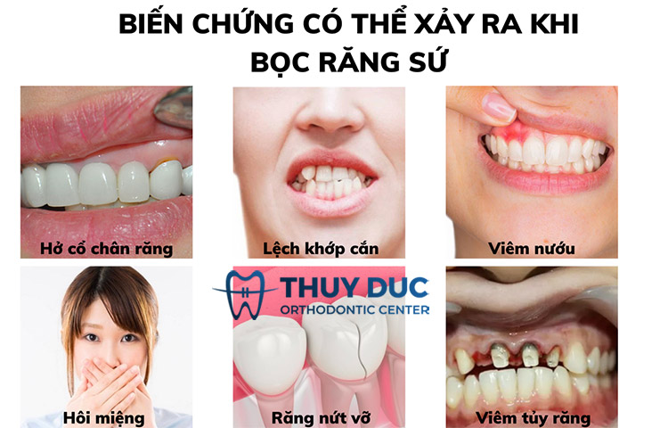 Các vấn đề có thể gặp phải khi bọc răng sứ 1